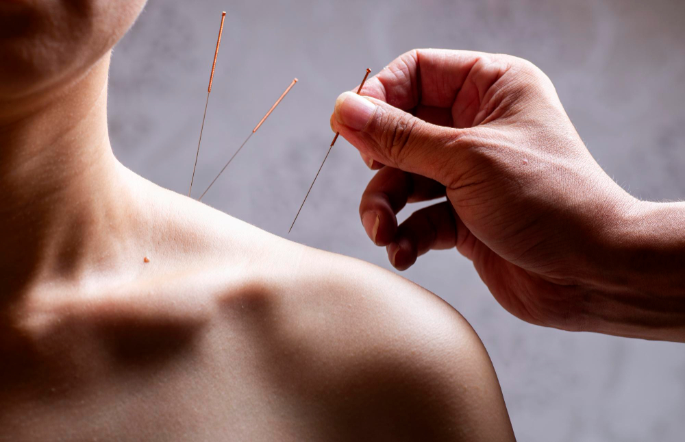 Acupuntura